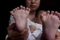 В КНР родился мальчик с 31 пальцем на руках и ногах 