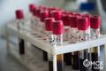 Омская область оказалась в списке регионов с высокой поражённостью ВИЧ-инфекцией